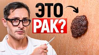 Родинка, которая может убить: признаки, которые нельзя игнорировать.