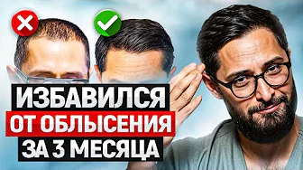 Мужское облысение - не приговор! Моя история избавления от залысин без пересадок